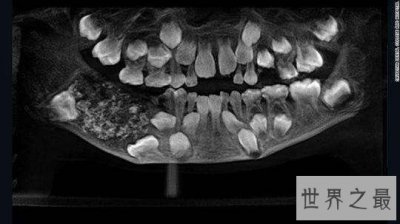 ​印度7岁男孩下颚肿胀,嘴里竟然多长了526颗牙齿